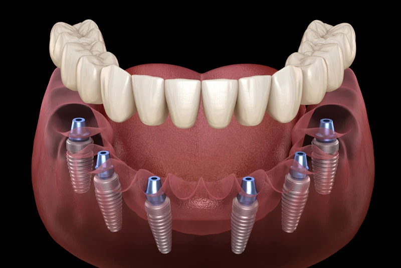 	Advantages of All-on-4 Dental Implants for Full Mouth Restoration