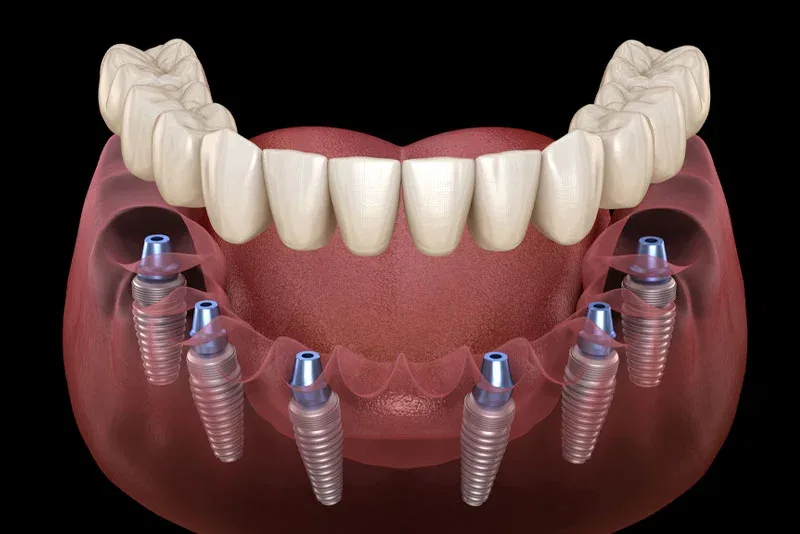 Advantages of All-on-4 Dental Implants for Full Mouth Restoration
