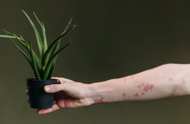 Living With Eczema Is More Than Just Managing Itch